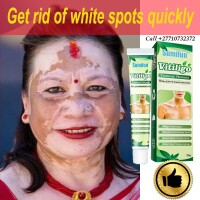 Get Rid Of Vitiligo In Jämjö Municipality in Sweden Call +27710732372 Scars And Stretch Marks In USA
